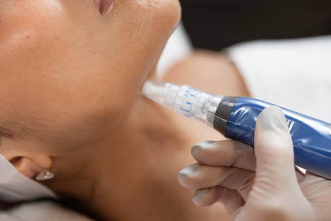 Close up of a lovely caucasian woman having microdermabrasion non invasive therapy with derma pen in a wellness center | Resa Medical Aesthetics in Scottsdale, AZ