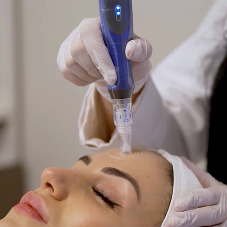 Microneedling, or collagen induction therapy treatment | Resa Medical Aesthetics in Scottsdale, AZ