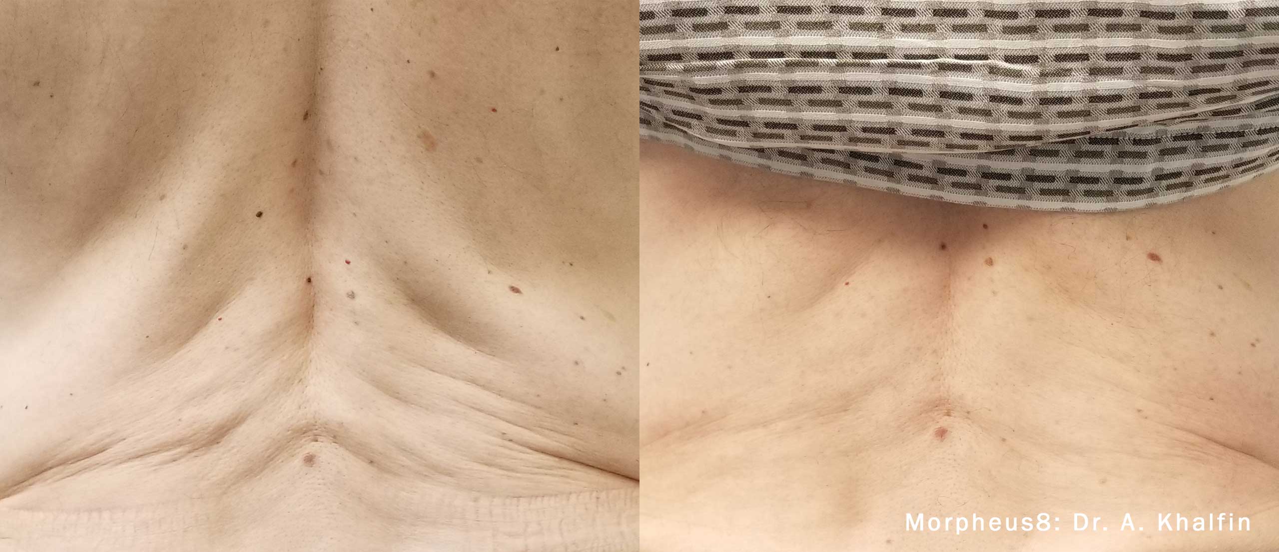Morpheus8 before and after, back rolls