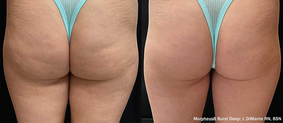 Morpheus8 before and after, buttocks