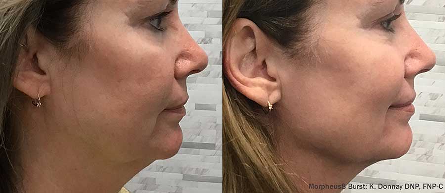 Morpheus8 before and after, jawline contouring