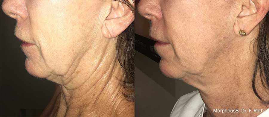 Morpheus8 before and after, neck tightening
