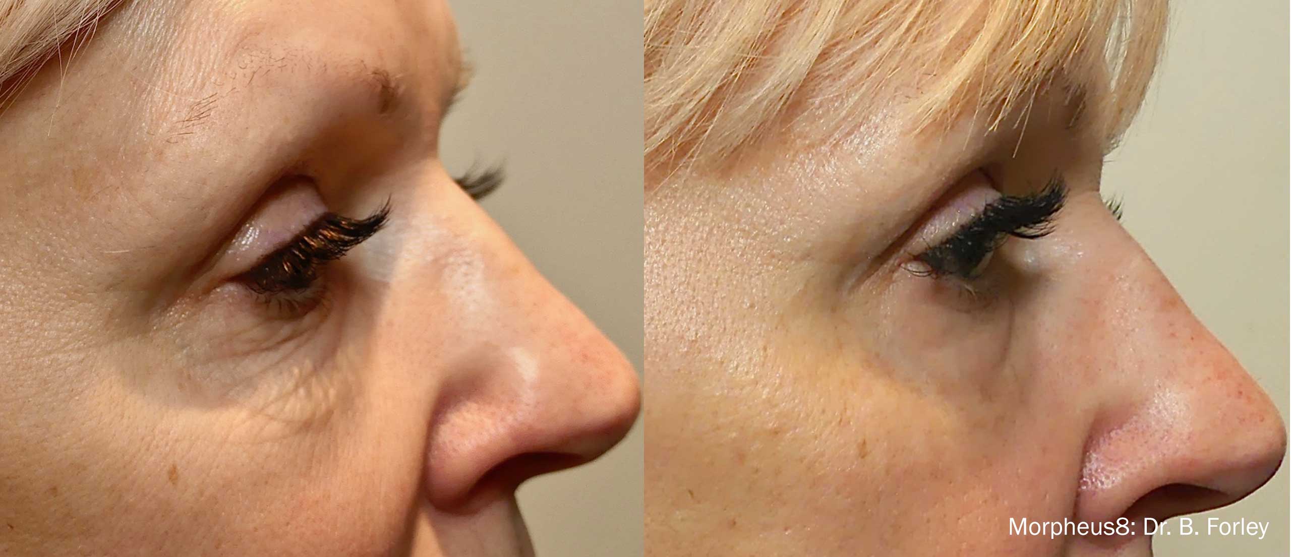 Morpheus8 before and after, under eye