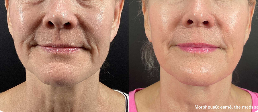 Morpheus8 before and after, smile lines and nasolabial folds