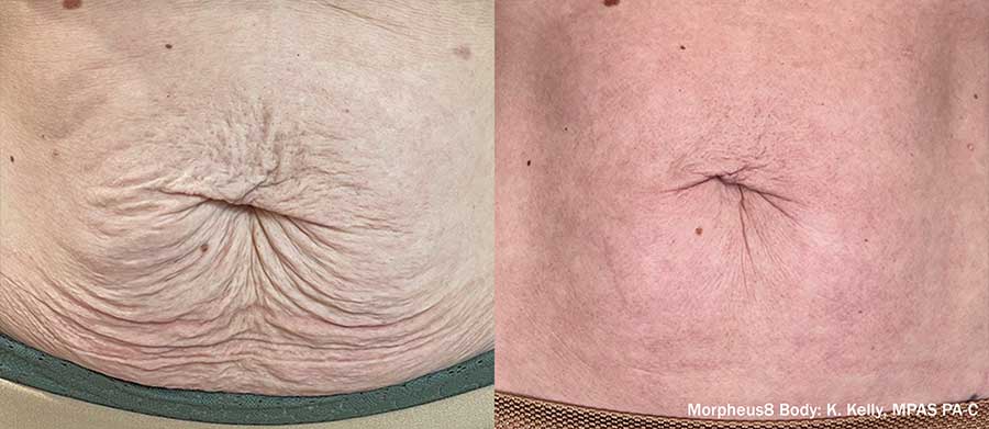 Morpheus8 Body before and after, abdomen